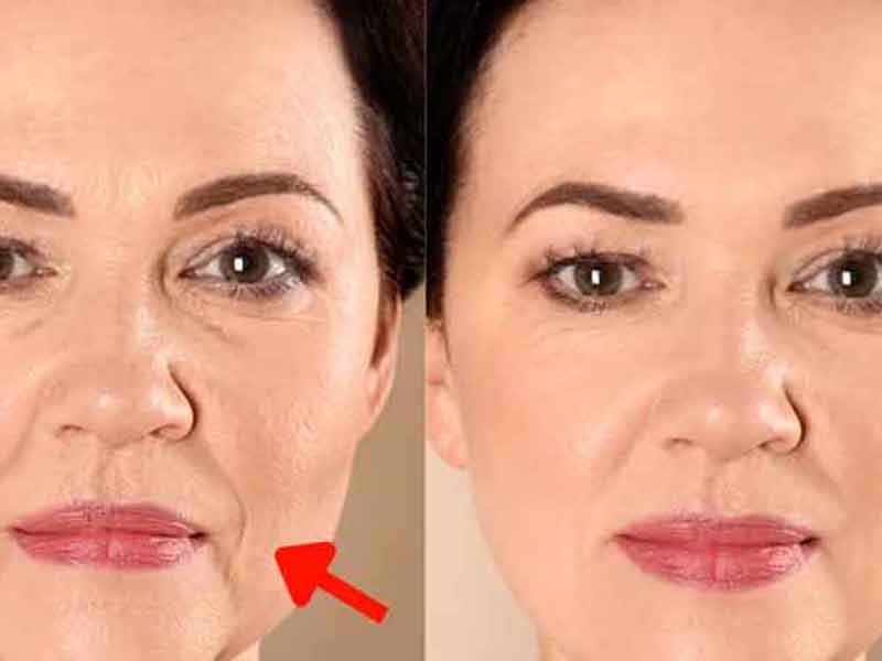 How Long Does Sculptra Last? How Many Sculptra Treatments Are Needed