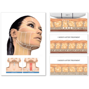 diagram of ultherapy